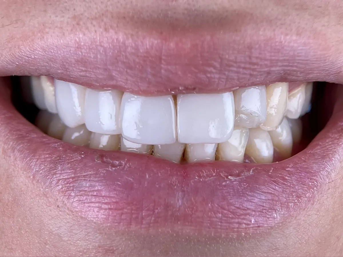 Antes del tratamiento — Diseño de sonrisa