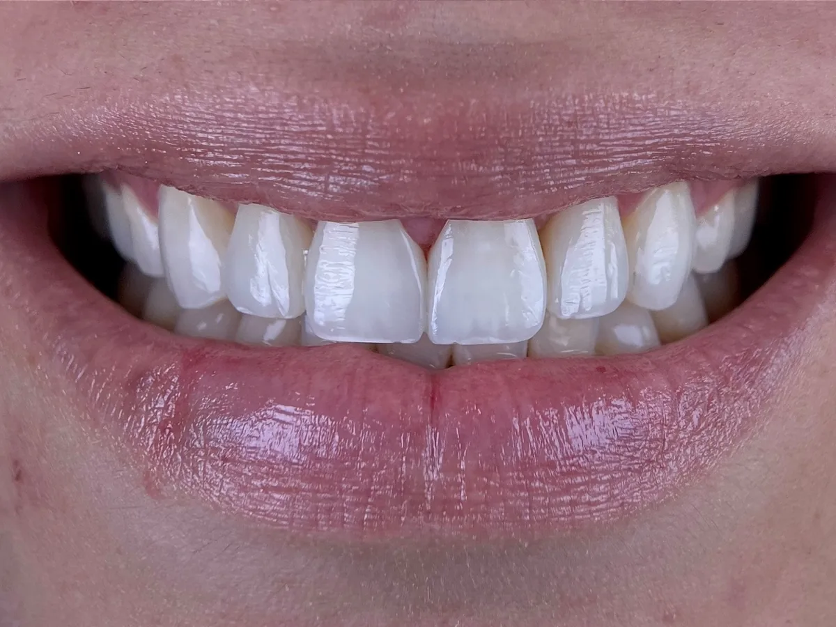 Después del tratamiento — Diseño de sonrisa