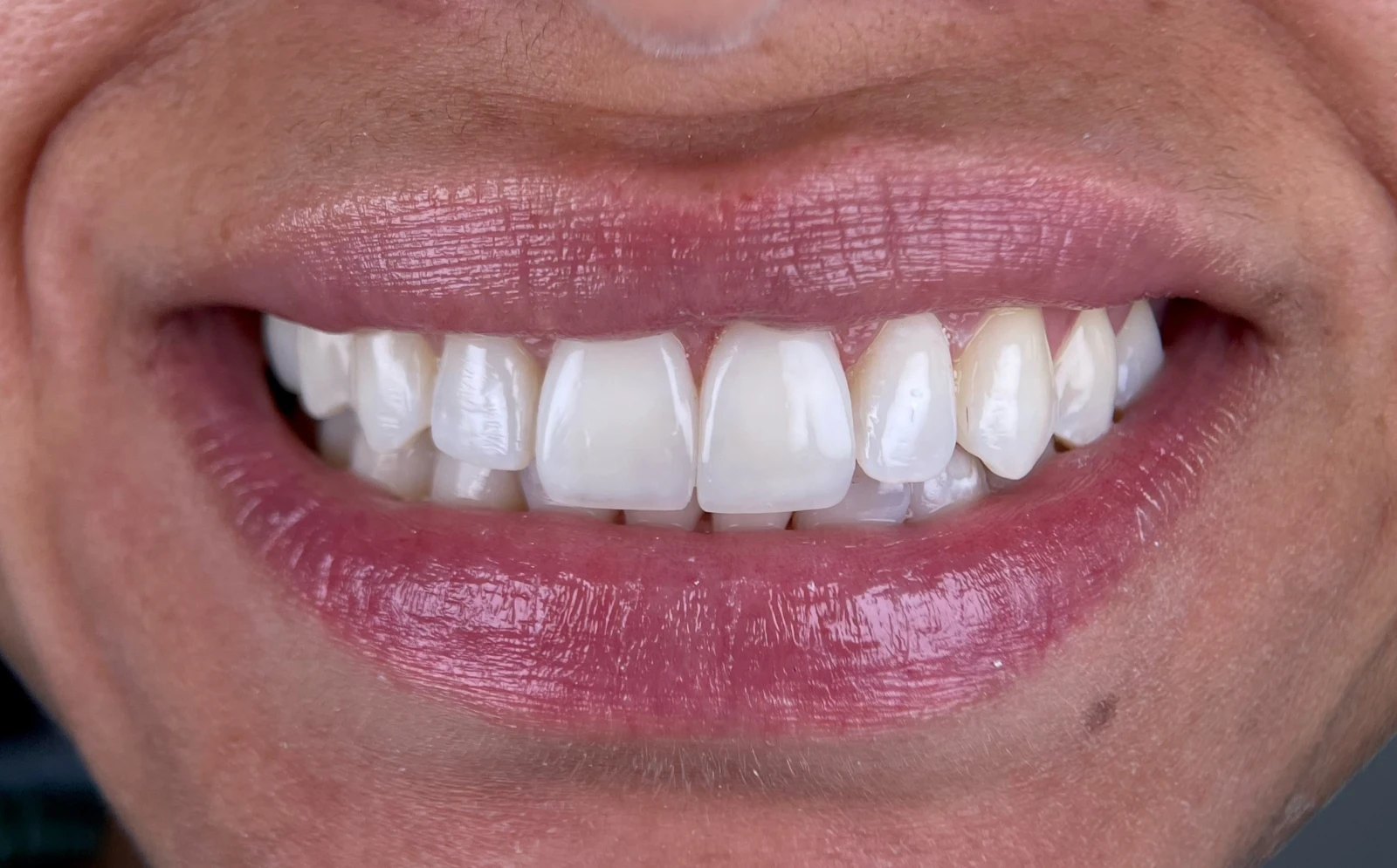 Estética dental