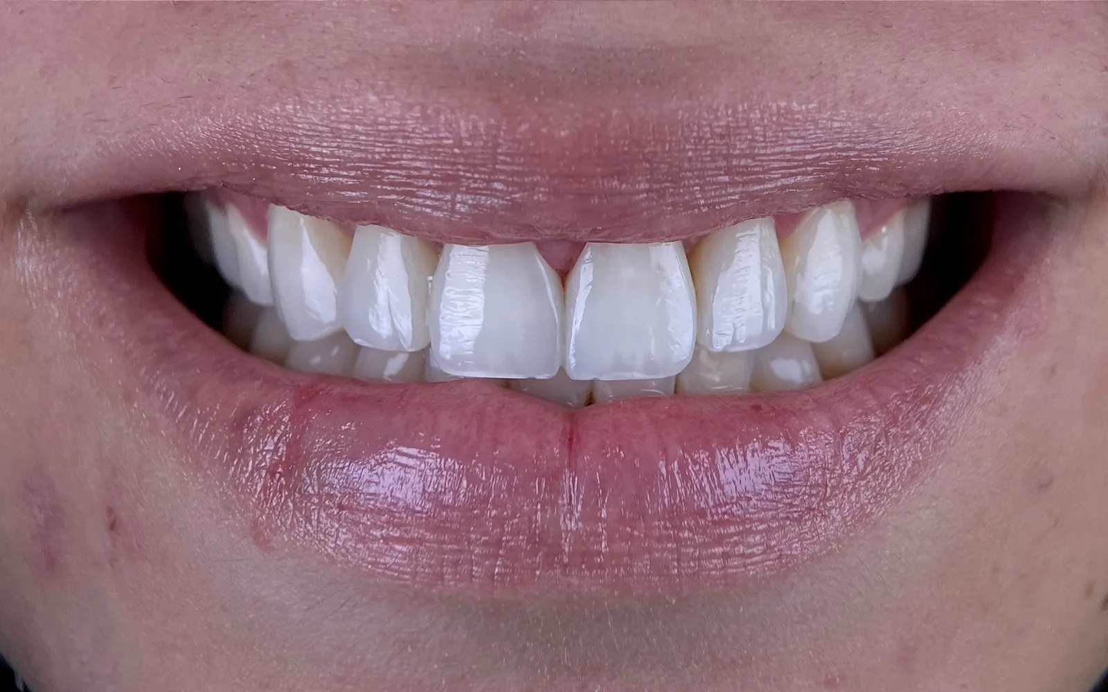 Estética dental